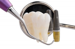 dental implants 