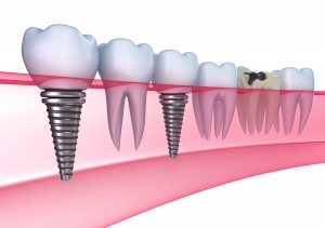 tooth implant