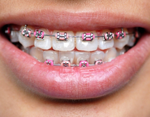 braces