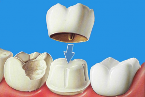 dental crowns