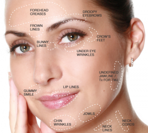 botox injections